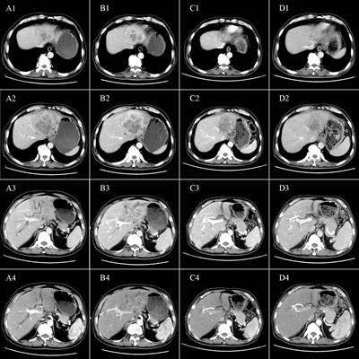 Case Report: Camrelizumab combined with gemcitabine and oxaliplatin in the treatment of advanced intrahepatic cholangiocarcinoma: a case report and literature review